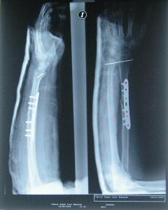 radiografía brazo.jpg
