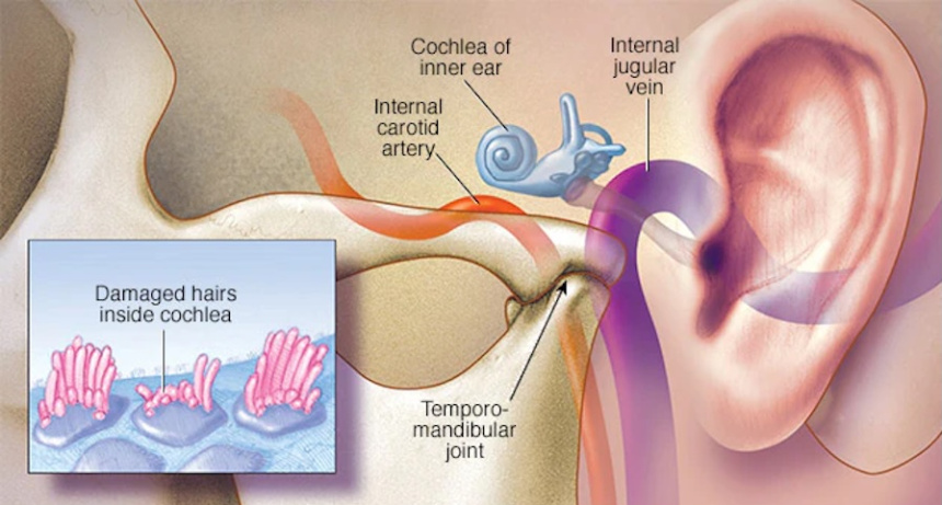 El tinnitus en el oído interno
