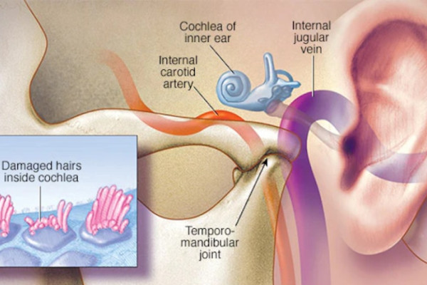 Científicos descubren posible causa del tinnitus: el cerebro "sube el volumen" cuando hay pérdida auditiva